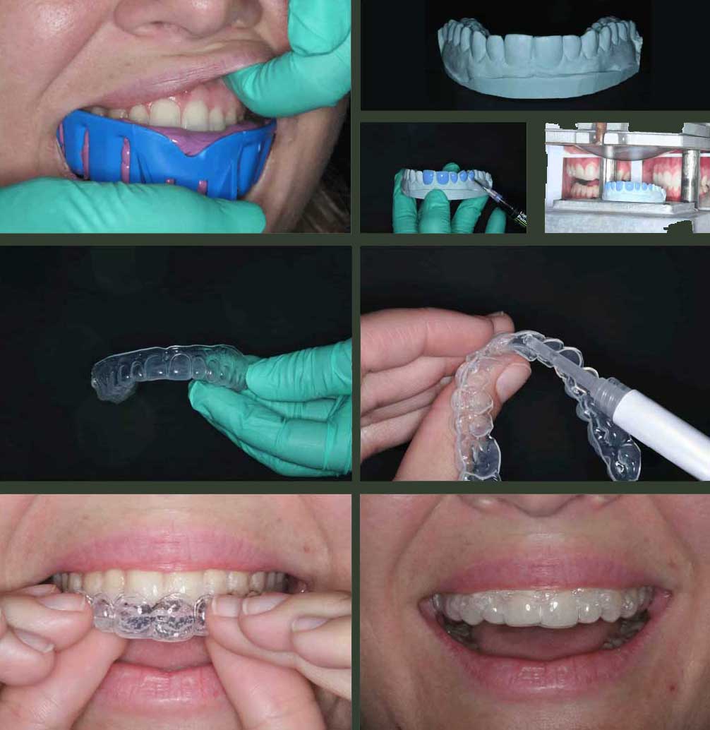 LUMIBRITE custom whitening tray
