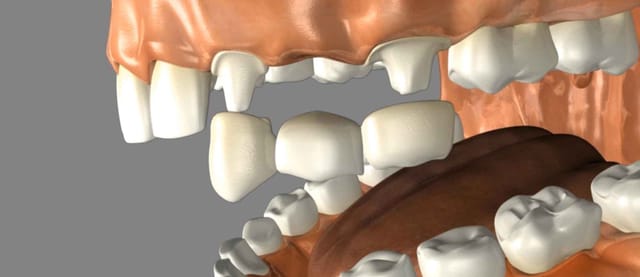 Dental Bridges Dental Bridge