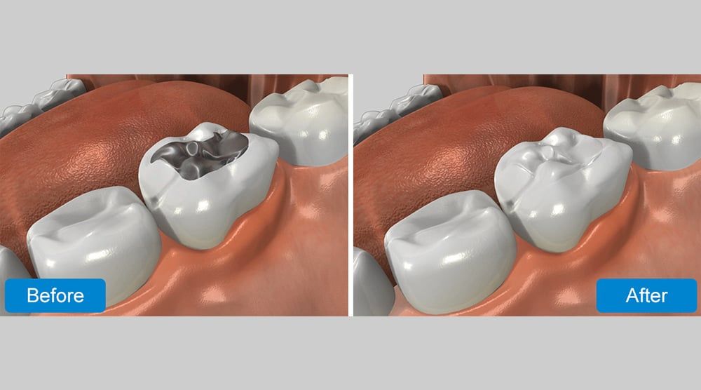 Edward P. Laco, DDS WHITE FILLINGS Loves Park