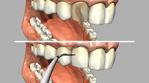 Porcelain Veneers Porcelain Veneers